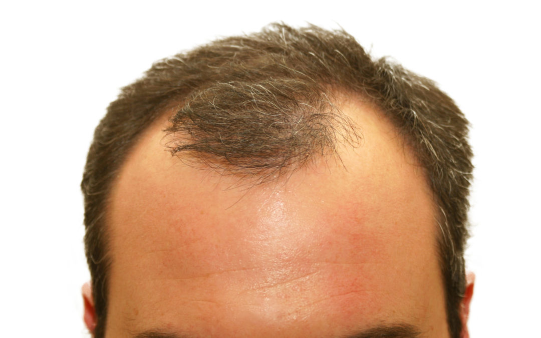 Great Advice for Thinning Hair